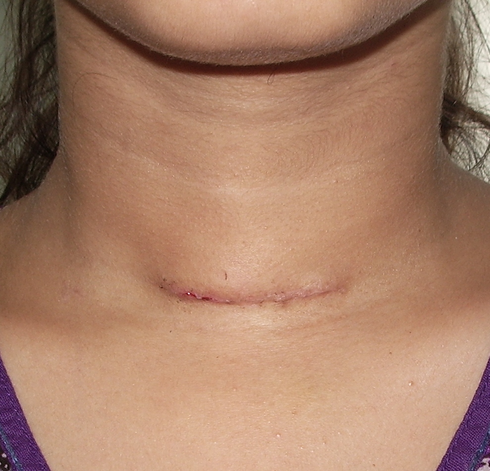 Thyroidectomy scar - one week after surgery
