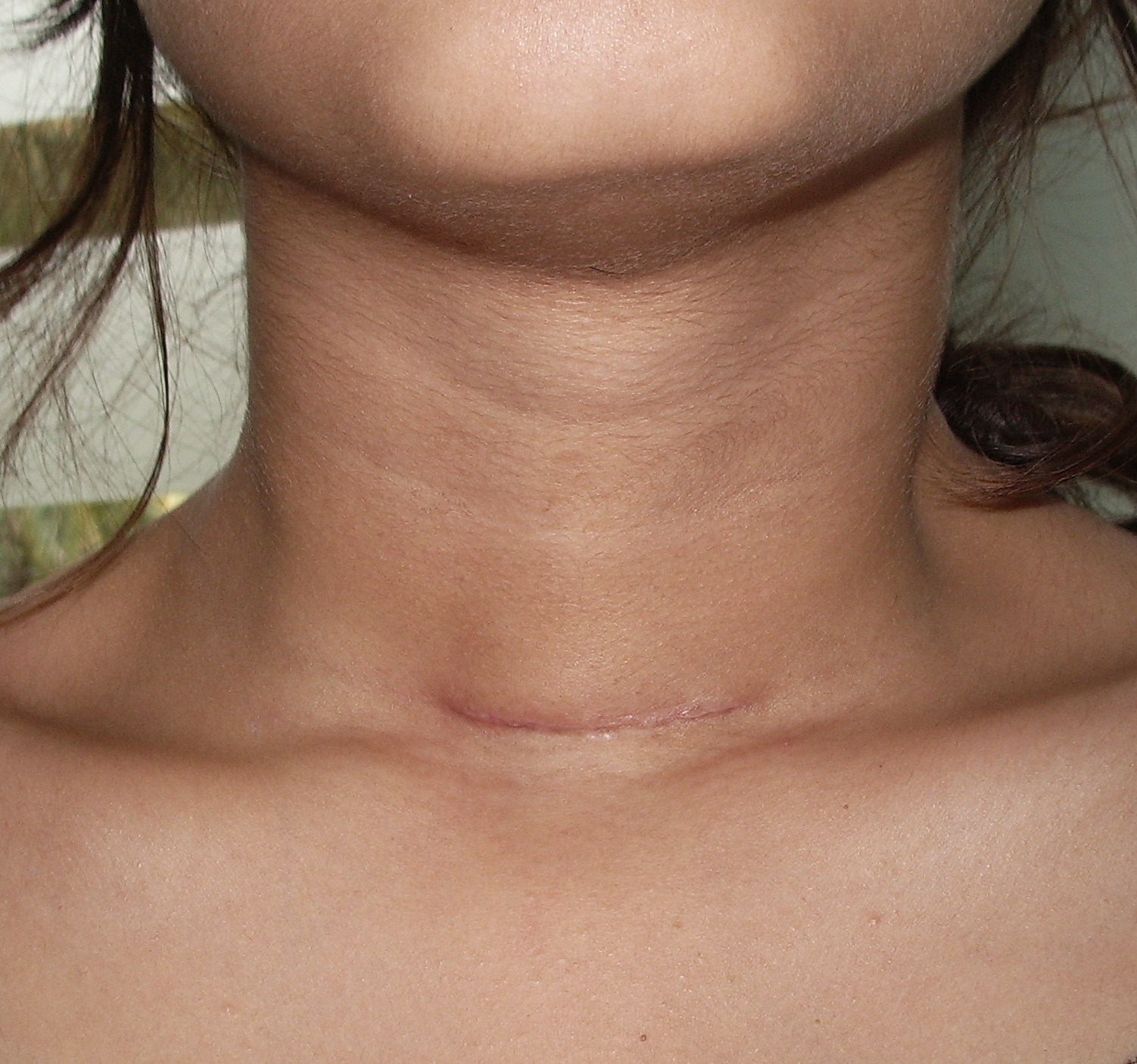 Thyroidectomy scar - one month after surgery