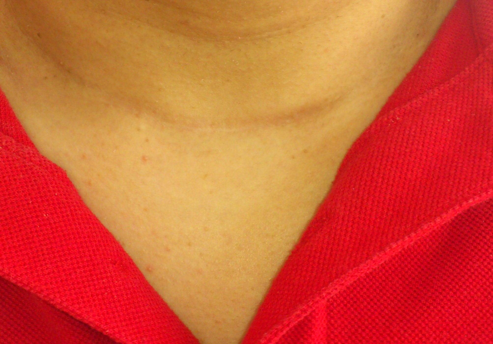 Thyroidectomy scar - one year later