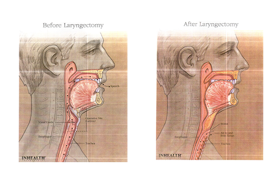 Throat Cancer Treatment in India